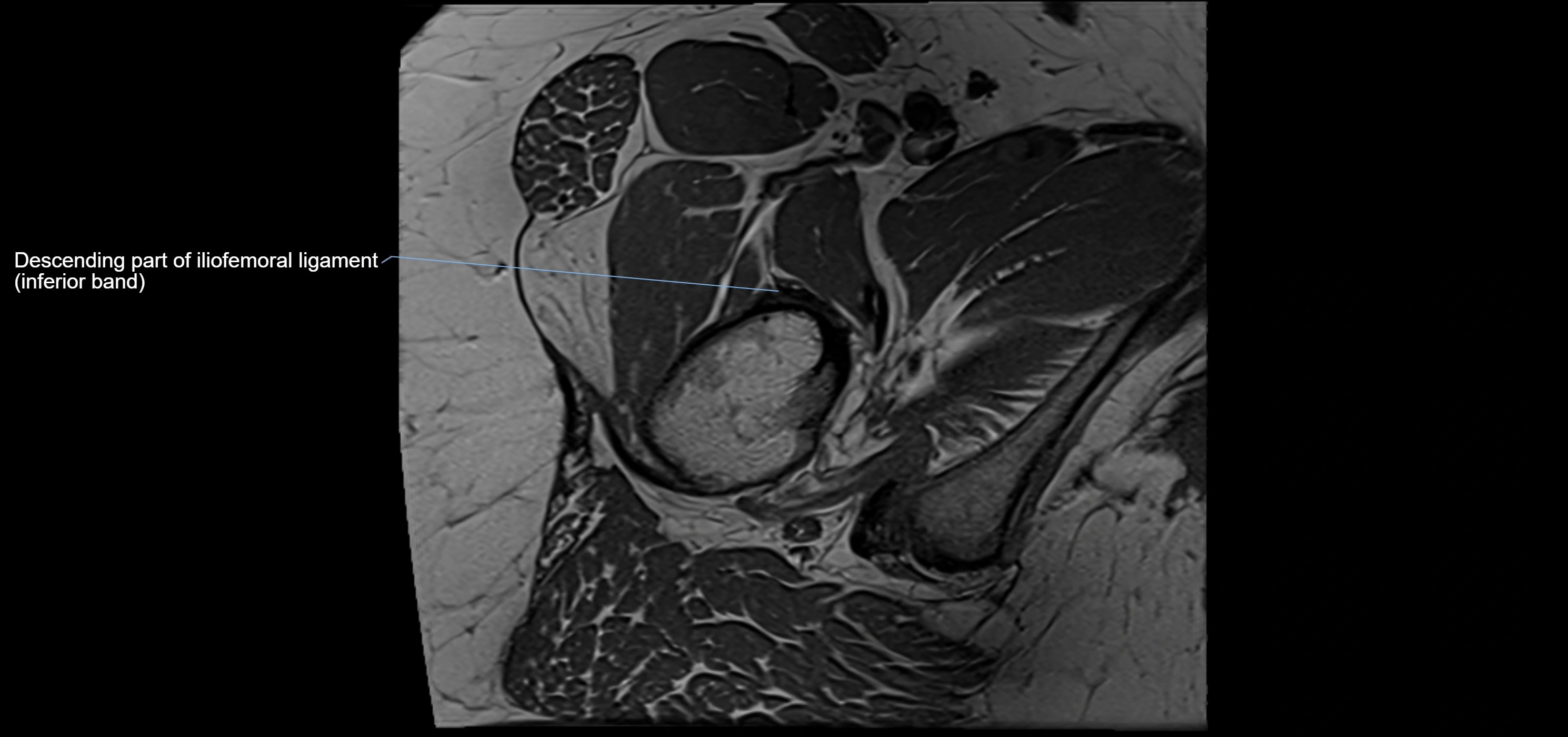 Hip ligament anatomy axial 3T MRI image -img-13001-00028.webp